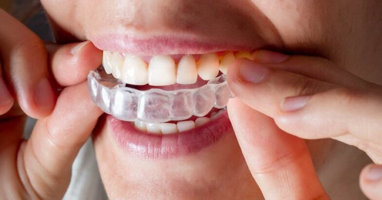Clear Aligners For Overbite Correction 785x411