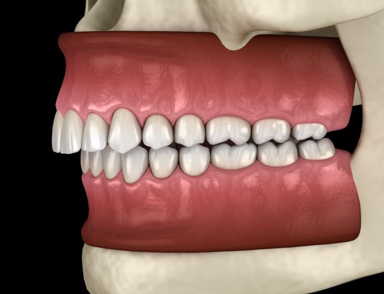 How Clear Aligners Help In Overbite Correction 785x602