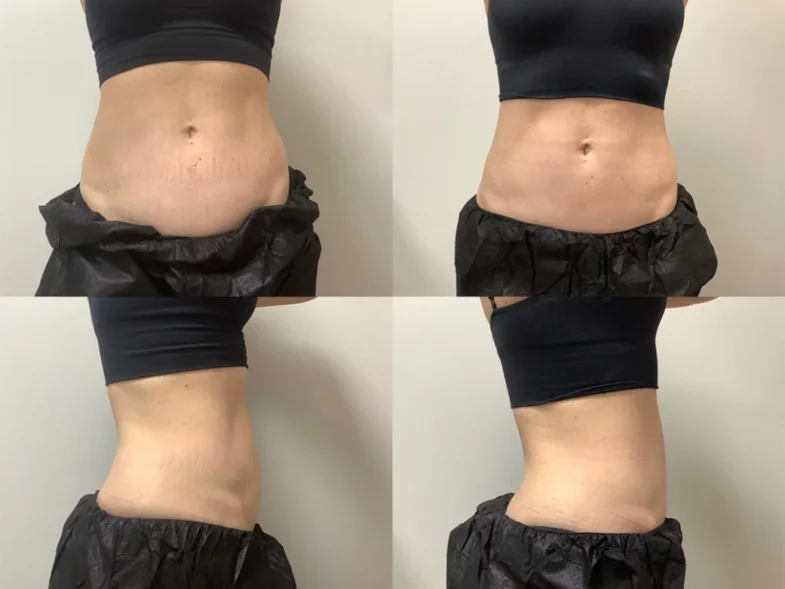 Fat Freezing Results